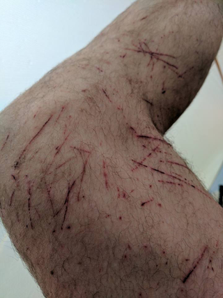 Wolpin’s leg post-Barkley